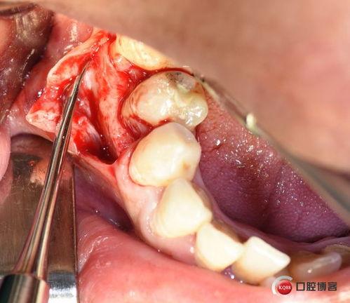 根尖囊肿切除手术视频,根尖囊肿切除手术全过程解析