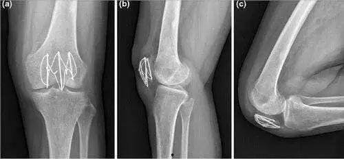 髌骨骨折弯曲训练视频,弯曲训练视频详解