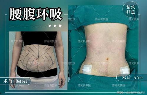 腰腹吸脂视频,重塑曲线，告别臃肿